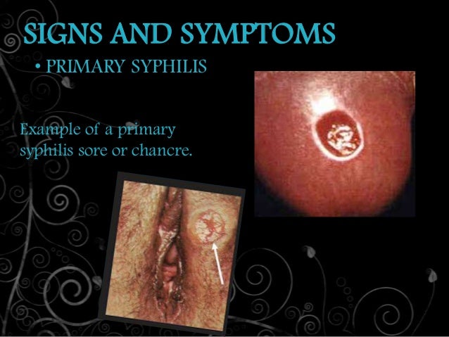 syphyllis in the vagina Syphyllis in the vagina